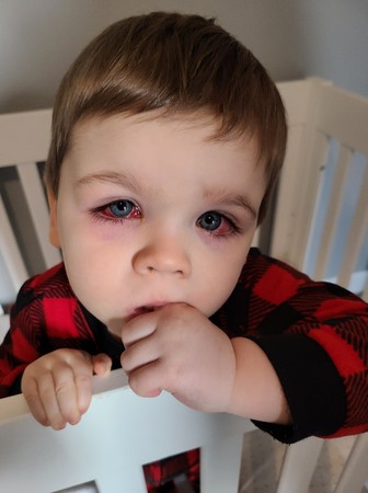 ▲▼艾登在臉書上貼出自己孩子雙眼紅腫的照片。（圖／翻攝自Facebook／Eden Strong）