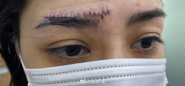 阿嬌爆頭「蜈蚣疤」爬上臉　秘密回港做醫美…3個月後磨皮去疤