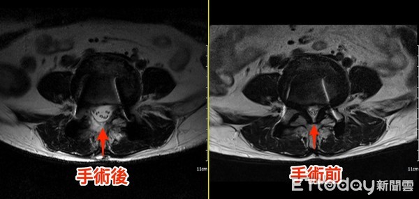 ▲微創脊椎內視鏡手術前後比較。（圖／記者黃孟珍翻翻攝）