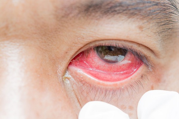 结膜炎眼睛红痒怎麼办?千万不要揉!眼科名医教你应急作法