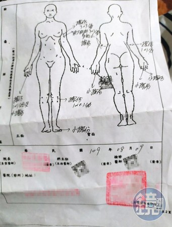 被害人H小姐事後赴醫院驗傷，並對男友提出傷害告訴。（讀者提供）