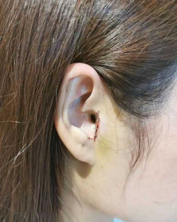 女子醫美手術後，耳朵缺了一塊。（圖／翻攝自澎湃新聞）
