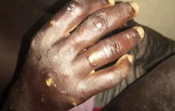 ▲▼塞內加爾出現詭異的皮膚疾病。（圖／翻攝自Youtube）