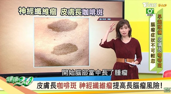 ▲▼神經纖維瘤。（圖／截自健康2.0）