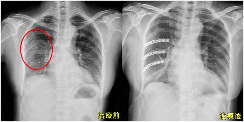 嚴重恐氣胸 呼吸衰竭 她摔車 斷6根肋骨 醫 當心3器官也遭殃 Ettoday健康雲 Ettoday新聞雲