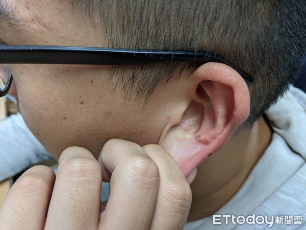 ▲▼耳廓假性囊腫由醫師提供,耳朵,揉耳朵。（圖／記者謝承恩攝）
