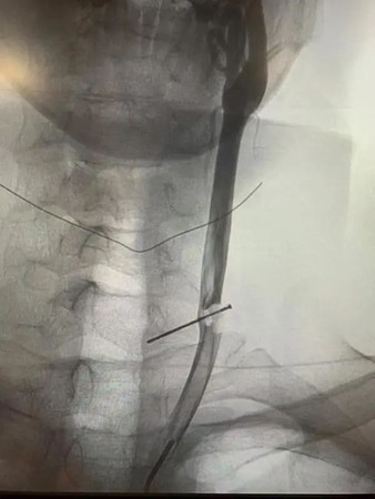 3公分鐵釘插進頸動脈！　健壯男頭暈發現：10年前插進去的。（圖／翻攝自錢江晚報）