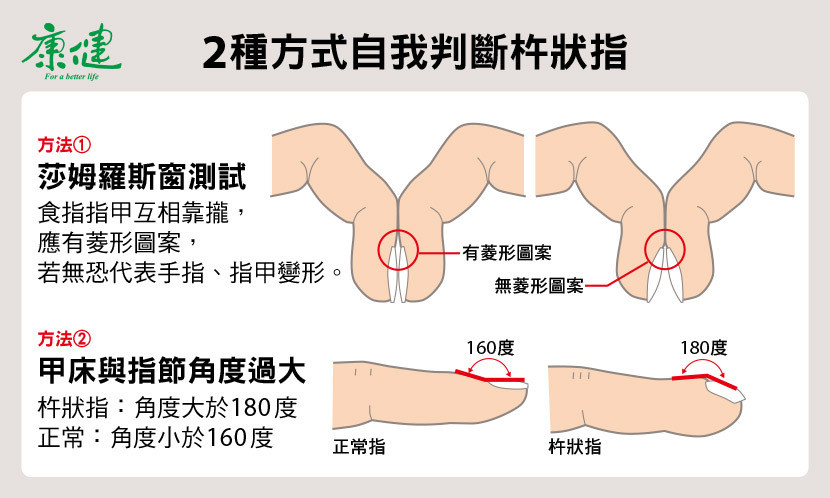 杵狀指 手指 指甲 心臟病 肺病 肺癌 慢性肺阻塞