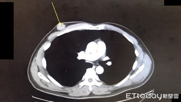 ▲陳男原以為是良性脂肪瘤的小硬塊（箭頭處），經檢查確認為罕見的男性乳癌。（圖／記者黃孟珍翻攝）