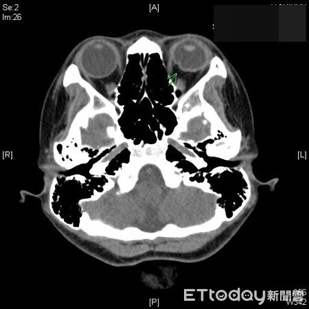 ▲少女左眼明顯萎縮（綠色箭頭處）。（圖／記者許宥孺翻攝）