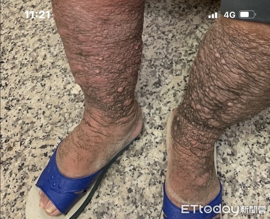 ▲▼退休翁因香港腳反覆破皮感染，導致兩腿水腫如象腿。（圖／李芳樑醫師提供）