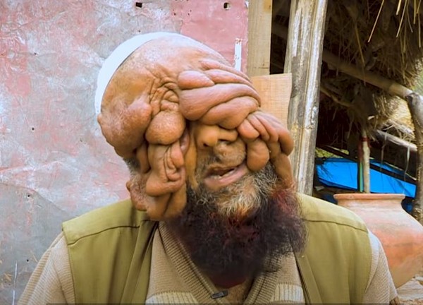 ▲▼一名印度男子整臉長滿腫瘤，幾乎失去視力。（圖／翻攝自YouTube／truly）