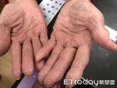 手乾裂脫皮「猛擦乳液都沒用」!醫揭6大壞習慣:是濕疹作怪