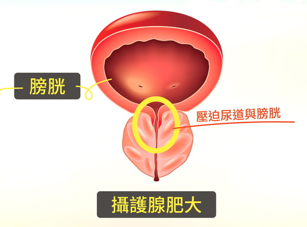 攝護腺嚴重肥大「尿不出險洗腎」　綠光汽化術挽回健康 | ETtoday健