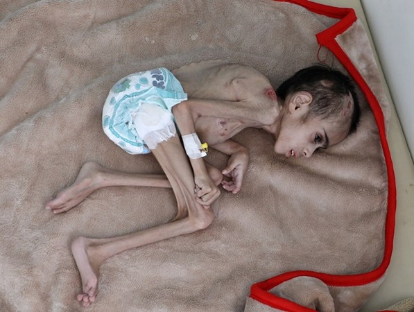 ▲葉門7歲男童費德（Faid Samim）嚴重營養不良。（圖／路透）