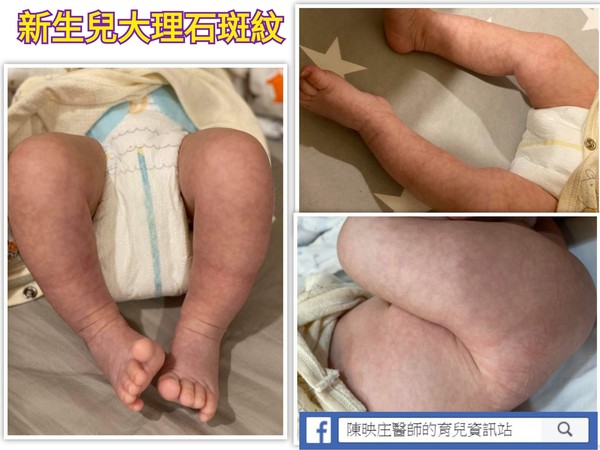 ▲▼醫師透露，新生兒四肢偶爾出現藍紫色網狀斑紋是正常現象，不用太過緊張。（圖／粉專陳映庄醫師的育兒資訊站提供）