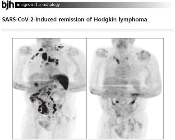 ▲▼《英國血液學雜誌》一項臨床案例報告顯示，病患在感染新冠肺炎後體內癌細胞大量消失。（圖／翻攝自British Journal of Haematology）