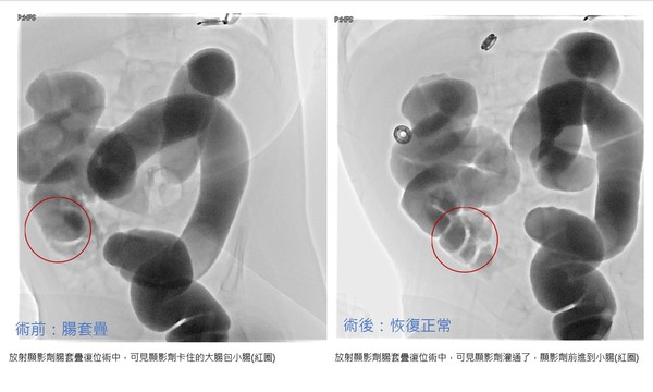 ▲▼一名4個月大嬰兒出現腸套疊症狀。（圖／中國醫藥大學新竹附設醫院提供）