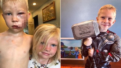 6歲娃護妹遭狗咬爛臉「頭縫90針」　2醫感動哭免費治療：我們的榮幸