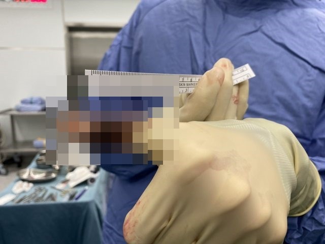 割完包皮 10公分剩4公分 他崩潰 醫揭殘酷關鍵 最少要留1 3 Ettoday健康雲 Ettoday新聞雲