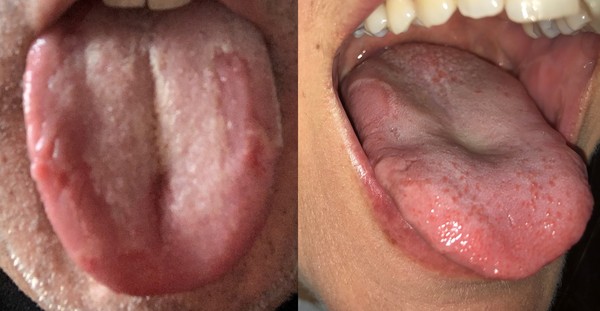 ▲▼越來越多新冠患者出現舌頭潰瘍的症狀。（圖／翻攝自Twitter／@timspector、@corispecial）