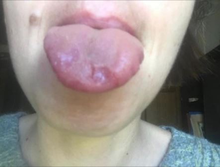 ▲▼越來越多新冠患者出現舌頭潰瘍的症狀。（圖／翻攝自Twitter／@timspector、@corispecial）