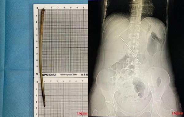 喝下朋友給的礦泉水！　38歲女忍劇痛4天...醫：體內有15cm長釘。（圖／翻攝自《紅星新聞》）