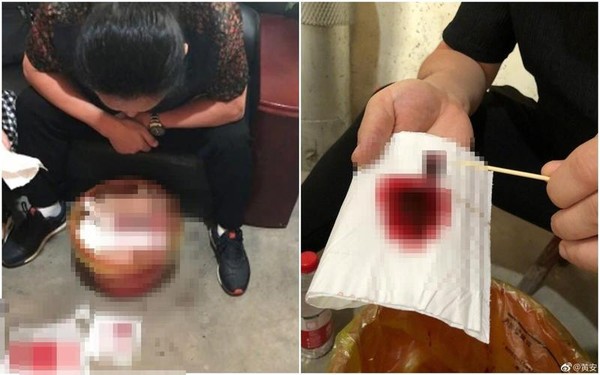 「台獨剋星」黃安也曾找中國「神醫」嘗試過「舌下取栓」的民俗療法。（翻攝自黃安微博）