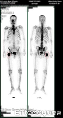 ▲張翁的核子骨骼掃描照，紅圈處顯示癌細胞轉移到大腿骨。（圖／衛福部彰化醫院提供）
