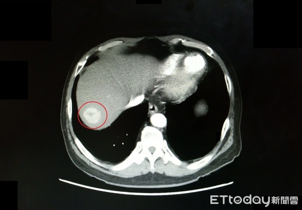 ▲劉男C肝治癒成功後，配合醫師定期追蹤，及早發現肝癌（紅圈處）並治療，順利恢復健康。（圖／記者黃孟珍翻攝）