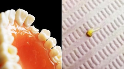 草莓種子在蛀牙裡發芽了！牙醫細挖病患齒縫：裡頭有滿滿細菌和營養