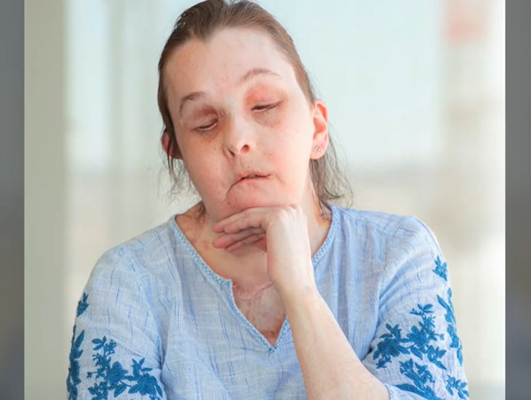 ▲來自美國佛蒙特州的卡門（Carmen Blandin Tarleton）接受第二次臉部移植手術。（圖／翻攝自YouTube／Brigham And Women`s Hospital）