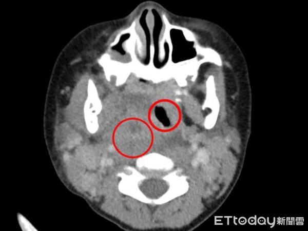 ▲左紅圈處是膿瘍位置，右紅圈處是氣管；正常情況下氣管應位於中央，但圖中情形則是咽喉部被膿瘍壓迫至對側。（圖／慈濟醫學中心提供，下同）