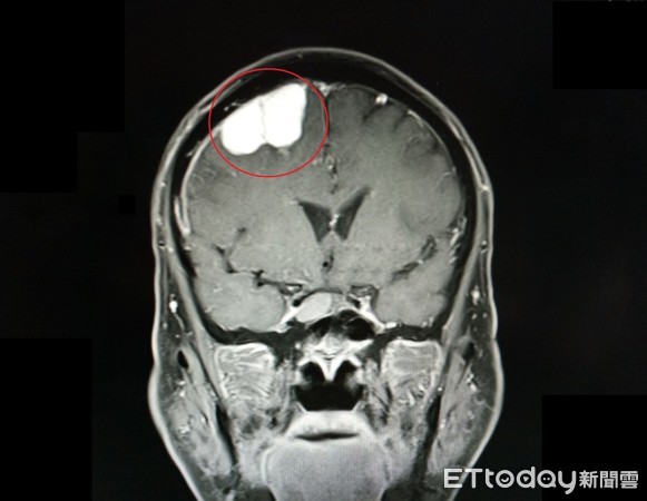 ▲羅姓男子因走路不穩跌倒就醫，檢查竟發現有3公分腦瘤(紅圈處)。（圖／記者黃孟珍翻攝）