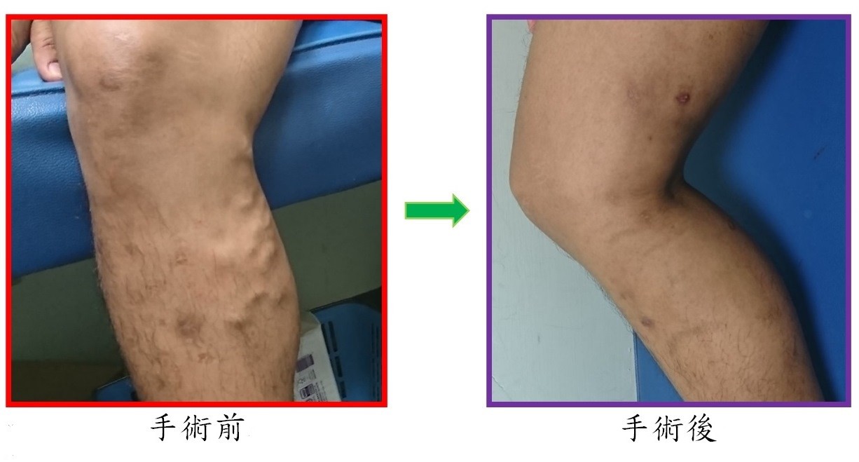 浮腫に最適な錠剤