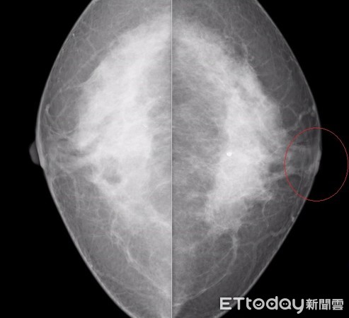 ▲婦人左側乳頭凹陷12年竟罹患乳癌 。（圖／部彰醫院提供）
