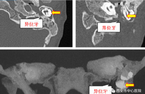 耳朵內長3顆牙齒！醫生為5歲男童重建聽力　意外得先「拔牙」。（圖／翻攝自微博／廣州日報）