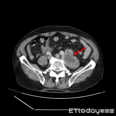 ▲老翁顧腰子狂喝草藥竟罹癌末期，輸尿管驚現比「扭蛋」大腫瘤。（圖／亞大醫院提供）