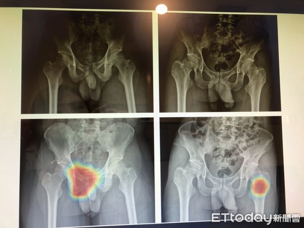 長庚AI輔助外傷影像診斷。（圖／記者趙于婷攝）