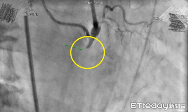 ▲黃圈處顯示陳姓患者右冠狀動脈完全阻塞。（圖／部立南投醫院提供）