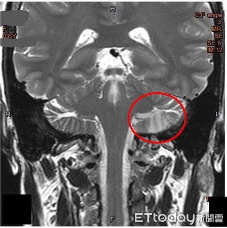 ▲在MRI檢查可發現，OL左側前下小腦動脈有梗塞情況。（圖／高醫提供）
