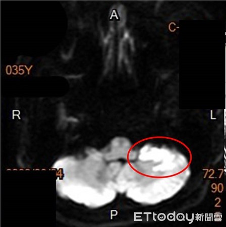 ▲在MRI檢查可發現，OL左側前下小腦動脈有梗塞情況。（圖／高醫提供）