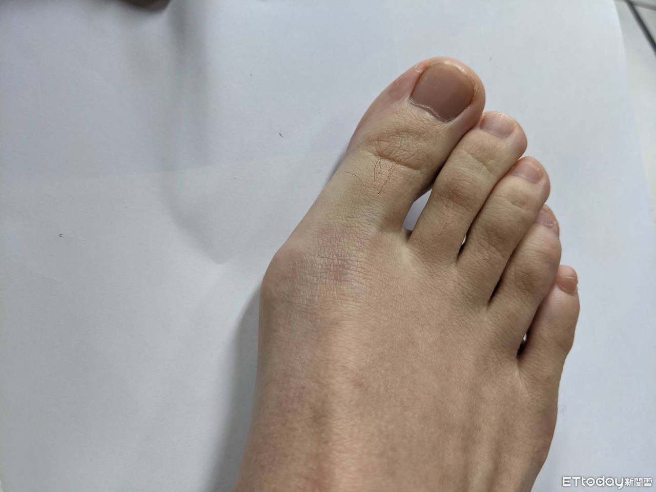 腳指甲3變化看身體健康！　醫點名「1徵兆」恐是癌 | ETtoday健康
