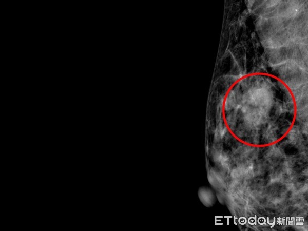 ▲乳房攝影，紅色圈為林小姐的乳癌腫瘤位置。（圖／慈濟醫學中心提供，下同）