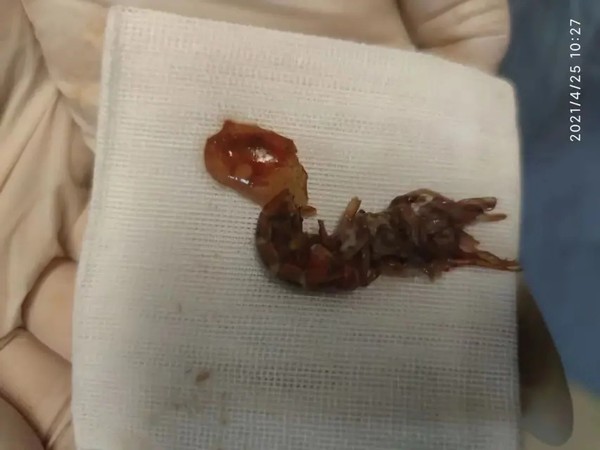 14歲少年把活小龍蝦塞進肛門　遭逆襲7小時竄腸道：醫生！快救我 | ET