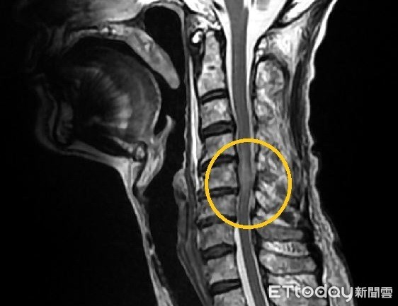 ▲黃圈處為患者頸椎第4至6節神經狹窄、脊髓嚴重水腫損傷。（圖／部立南投醫院提供）
