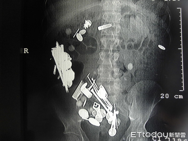 ▲吞食異物的X光影像（網路示意圖，非當事病人）。（圖／台中榮總埔里分院提供）
