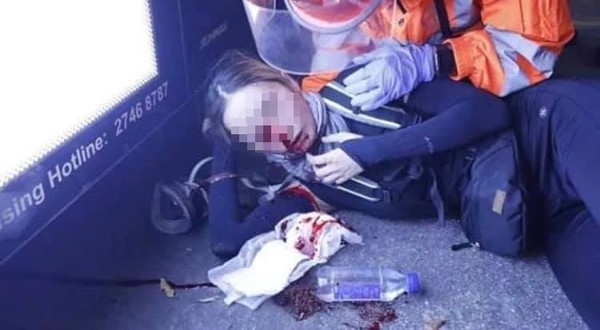 ▲香港反修例運動中傳出有少女右眼遭布袋彈襲擊，當場血流如注。（圖／翻攝臉書）