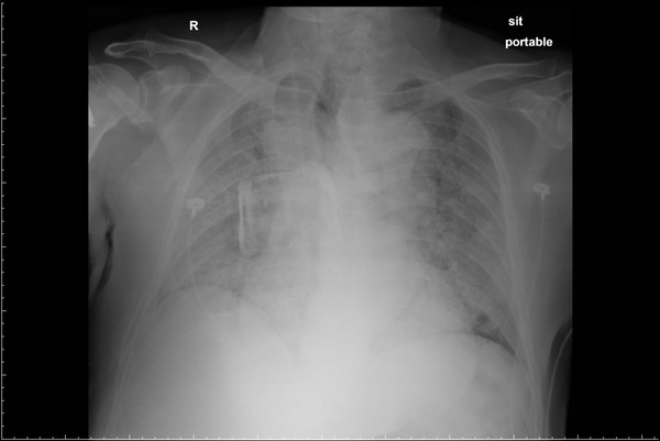肺部「都白掉了」X光照曝！只咳一天24小時亡　醫：只會越來越多 | ET