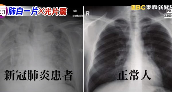 確診者vs.正常人！「肺部恐怖對比」照片曝　醫生：有不可逆傷害 | ET